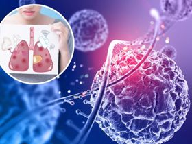 GIẢI ĐÁP: Ung thư phổi có di truyền không?
